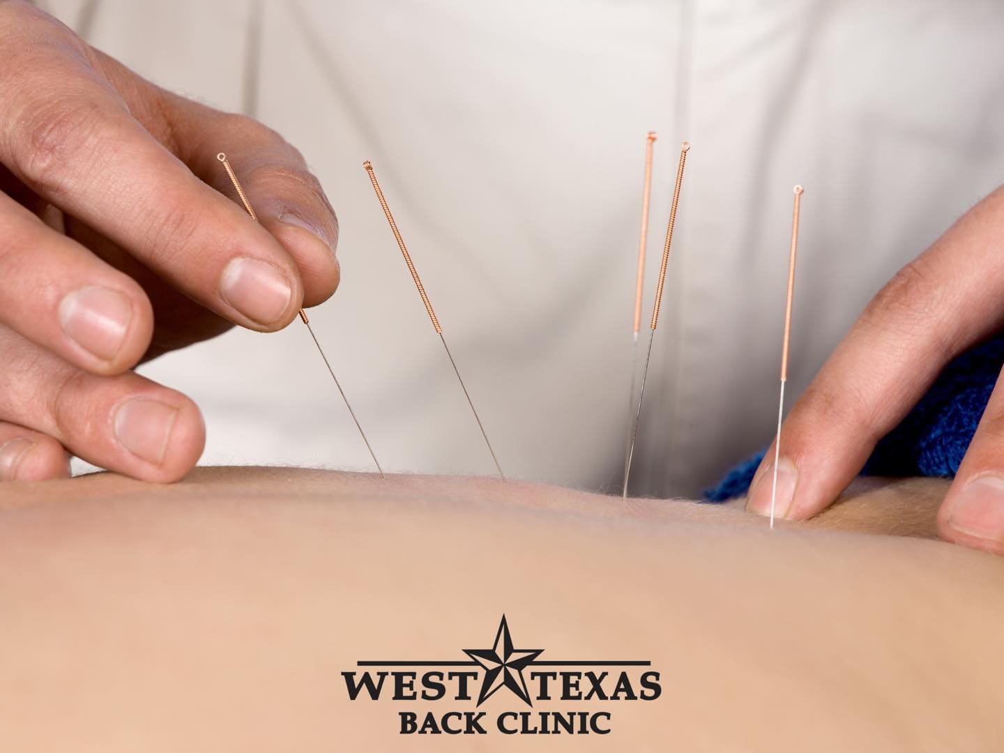 Acupuncture graphic by West Texas Back Clinic
